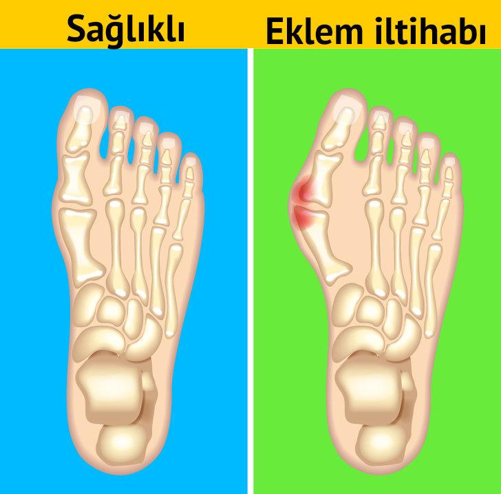  AÄrÄ±lÄ± ayak eklemleri