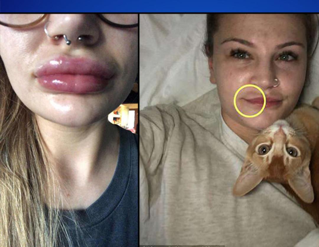 Bir skandal daha! Dudakları bu hale geldi, doktorun s&ouml;zleri şoke etti: Oral seks...