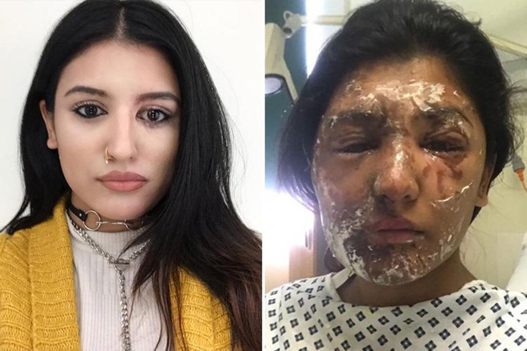 &Ccedil;ok şaşıracaksınız! Asit saldırısından sonra bakın nasıl değişti...