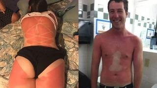 Bir yaz klasiği: Amele yanığı sanatı!