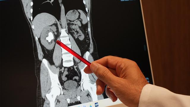Hiç ağrı yapmadan sessizce büyümüş! Böbreğindeki koca taş sırtından çıkarıldı