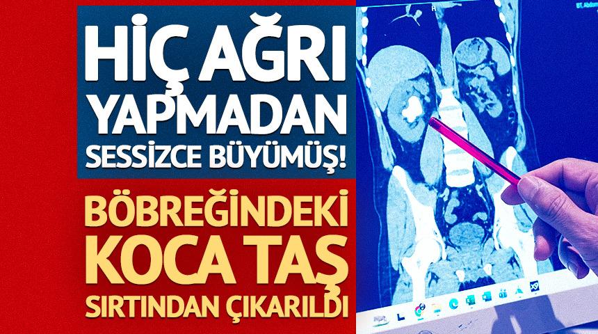 Hi&ccedil; ağrı yapmadan sessizce b&uuml;y&uuml;m&uuml;ş! B&ouml;breğindeki koca taş sırtından &ccedil;ıkarıldı