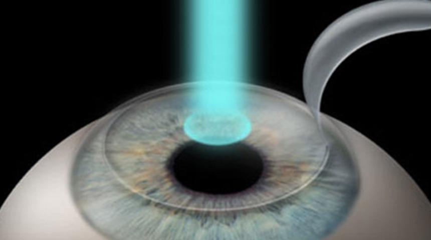 Miyop tedavisinde laser yöntemi