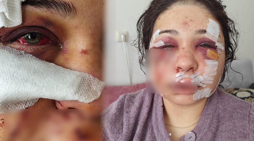 Polis eşi y&uuml;z&uuml;n&uuml; kesmişti! Şiddete uğrayan kadına hapis cezası