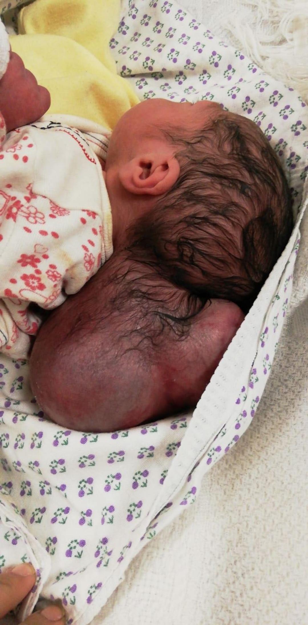 Hatay'da iki kafalı bebek doğdu!