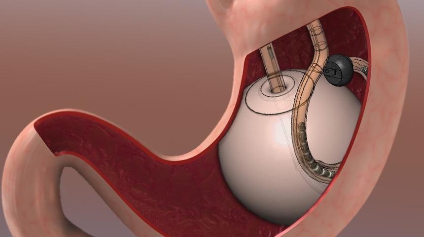 Mide balonu nedir? Mide balonu obezite hastalarına umut oldu