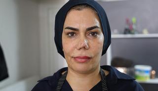 Burnu kırıldı, d&uuml;zelttirmek isterken hayatı kabusa d&ouml;nd&uuml;! &ldquo;Her seferinde farklı bir burun ortaya &ccedil;ıktı&rdquo;