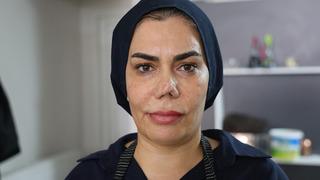 Burnu kırıldı, düzelttirmek isterken hayatı kabusa döndü! “Her seferinde farklı bir burun ortaya çıktı”