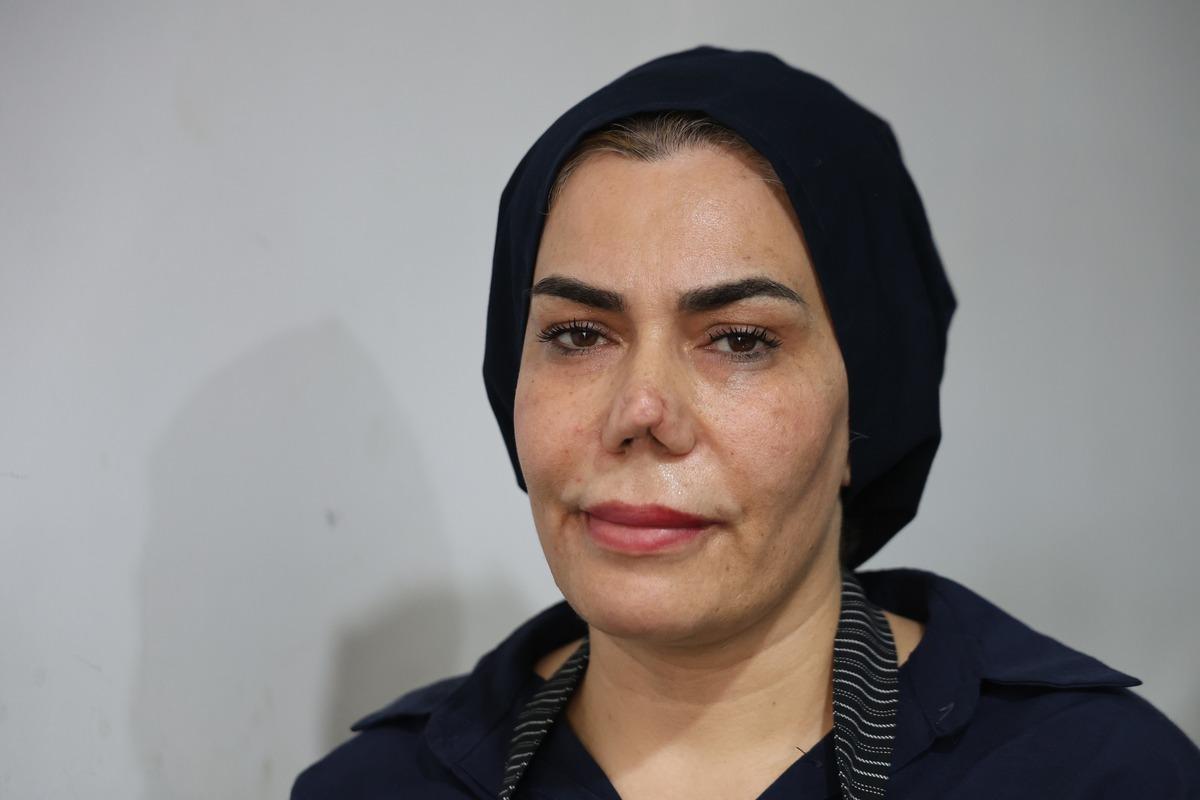 Burnu kırıldı, d&uuml;zelttirmek isterken hayatı kabusa d&ouml;nd&uuml;! &ldquo;Her seferinde farklı bir burun ortaya &ccedil;ıktı&rdquo; 2