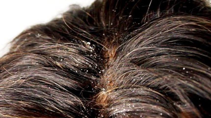 Kepek problemini k&ouml;k&uuml;nden &ccedil;&ouml;zen 4 ev &ccedil;&ouml;z&uuml;m&uuml; y&ouml;ntem