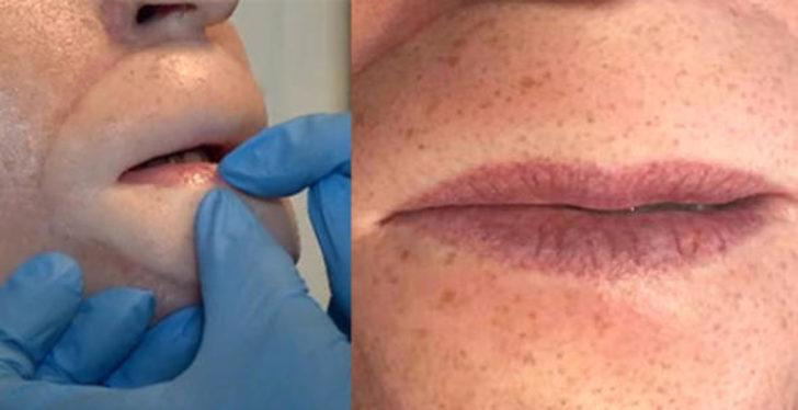 Et yiyen bakteri günden güne bedenini yok ediyor! G5