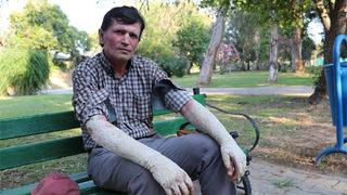 Hayatı kâbusa döndü! İnsanlar onu görünce korkup kaçıyor