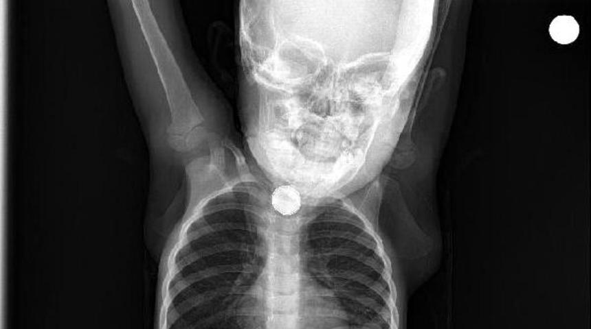 Batman'da 1,5 yaşındaki Berfin Ramazanoğlu'nun yuttuğu pil operasyonla alındı!