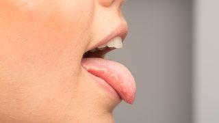 Tükürük bezi tümörü belirtisi nedir? Tükürük bezi tümörü neden olur? Tükürük bezi tümörü tedavisi için ne yapmalı?