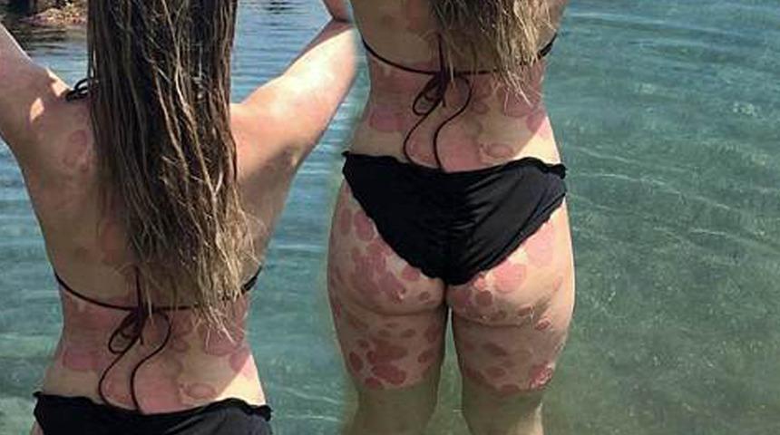 Sedef hastalığıyla mücadele eden kadın, ilham kaynağı olmak istiyor