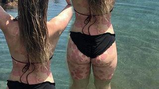 Sedef hastalığıyla mücadele eden kadın, ilham kaynağı olmak istiyor