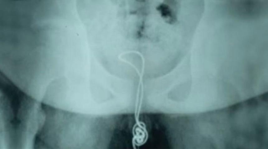 Şaşırtan olay! Cinsel organına USB kablosu sıkıştı