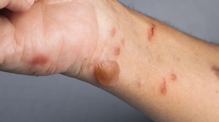 Kaynar su yanık tedavisi için hayat kurtaran ilk yardım önerileri