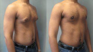 Erkeklerde meme büyümesi (jinekomasti) hakkında merak edilenler