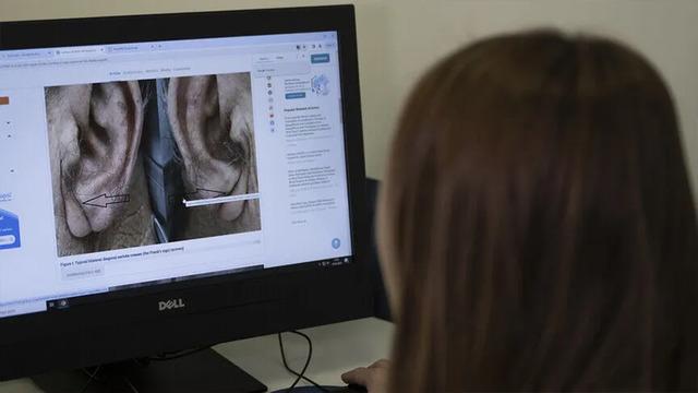 Kulak memenizde bu çizgi varsa dikkat! Kalp sağlığınız için önemli uyarı