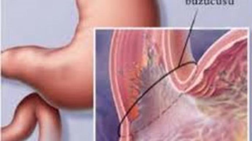 Refl&uuml; hafife alınmamalı kansere &ccedil;evirebilir