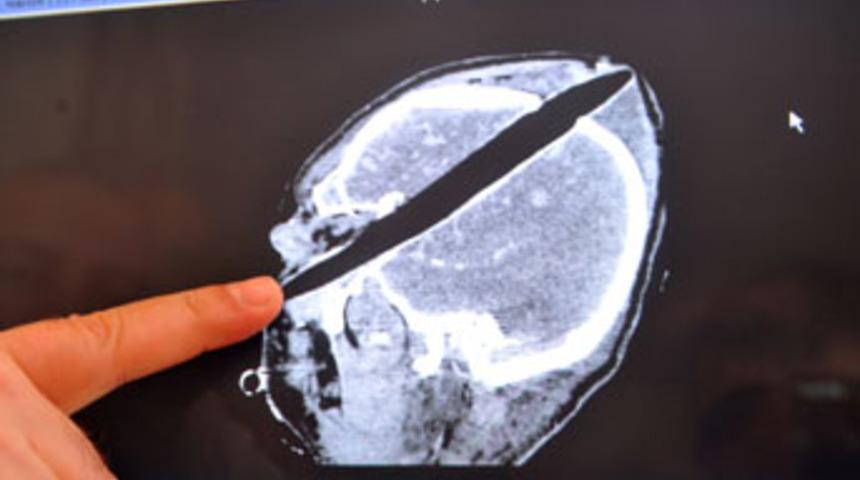 Başına 30 santimlik tahta par&ccedil;ası saplandı