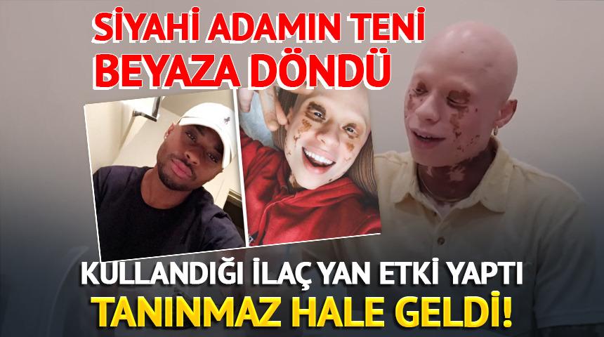 Kullandığı ila&ccedil; yan etki yaptı tanınmaz hale geldi! 