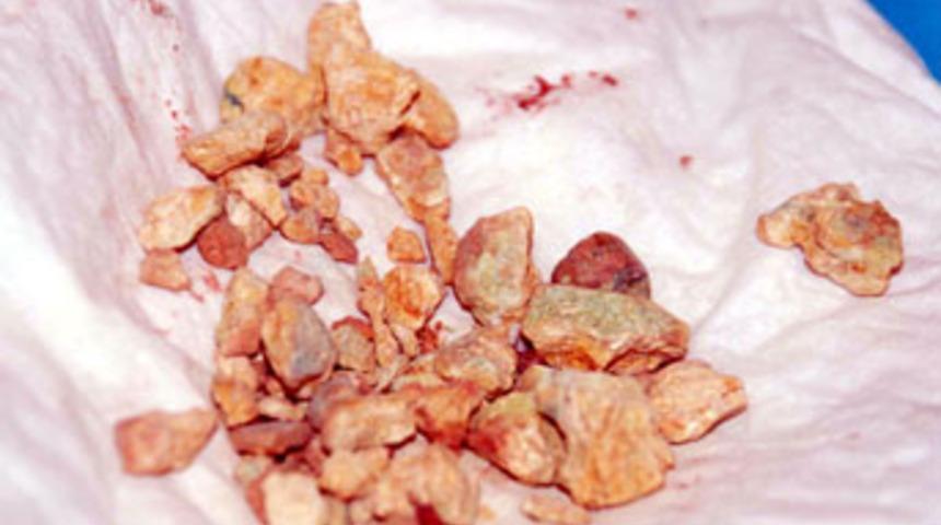 B&ouml;breklerinden 86 taş &ccedil;ıktı