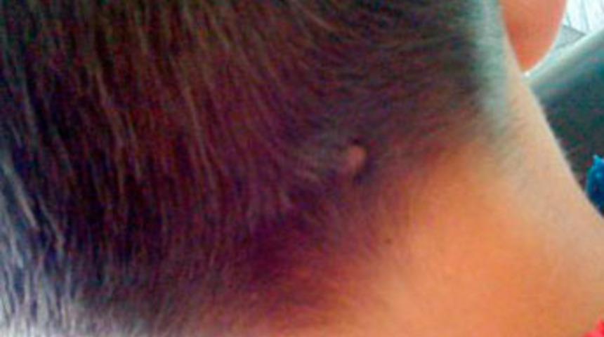 Kene ensesinden ısırdı