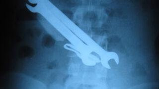 Midesinden çıkanlar görenleri şaşırttı