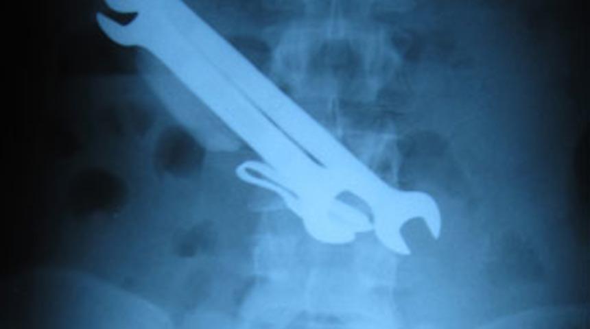 Midesinden çıkanlar görenleri şaşırttı