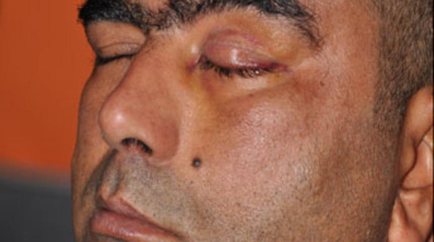 G&ouml;z kapağına altın takıldı