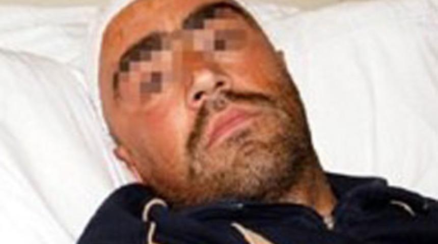 Bunalıma girdi, başına &ccedil;ivi &ccedil;aktı