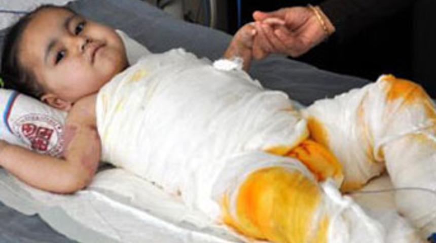 3 yaşındaki &ccedil;ocuğa deri nakli