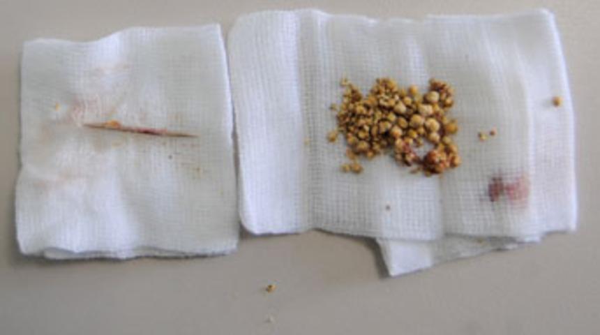 Safra kesesinden k&uuml;rdan &ccedil;ıktı