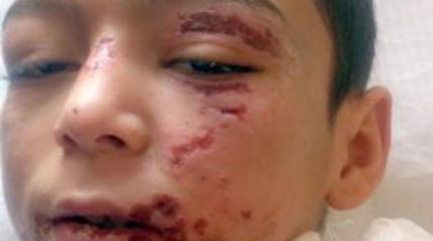 &Uuml;vey anne &ccedil;ocuğun cinsel organını yakıp, kafasındaki yarayı iğne iplikle dikmiş