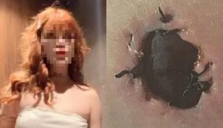 G&ouml;ğ&uuml;s b&uuml;y&uuml;tme ameliyatı sonrası &ldquo;deri kopması&rdquo; iddiası!