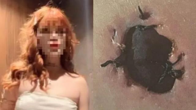 G&ouml;ğ&uuml;s b&uuml;y&uuml;tme ameliyatı sonrası &ldquo;deri kopması&rdquo; iddiası!