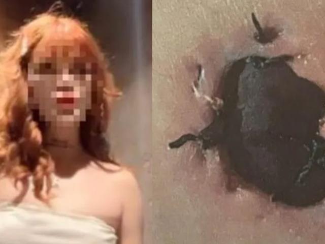G&ouml;ğ&uuml;s b&uuml;y&uuml;tme ameliyatı sonrası &ldquo;deri kopması&rdquo; iddiası!