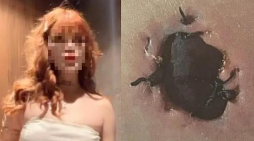G&ouml;ğ&uuml;s b&uuml;y&uuml;tme ameliyatı sonrası &ldquo;deri kopması&rdquo; iddiası! Profesyonel dans&ccedil;ı soluğu savcılıkta aldı
