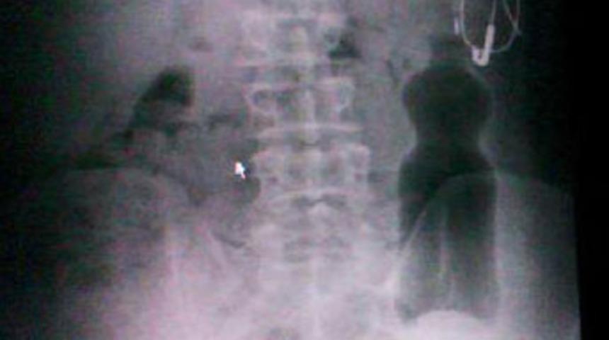 Makatından pet şişe girdi