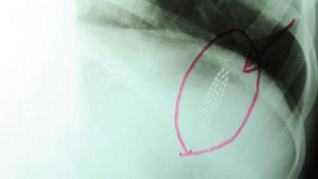 19 santimlik diş fırçasını yuttu