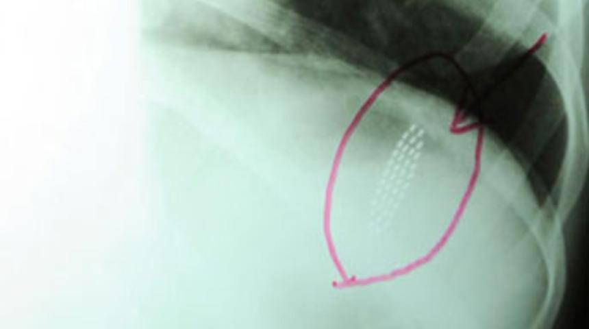 19 santimlik diş fırçasını yuttu