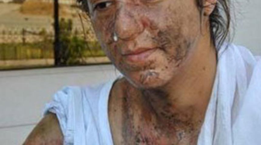 Eşinin &uuml;zerine asit d&ouml;k&uuml;p yaktı