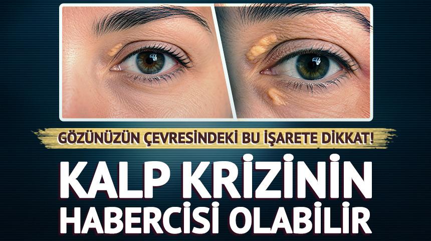 G&ouml;z&uuml;n&uuml;z&uuml;n &ccedil;evresindeki bu işarete dikkat! Kalp krizinin habercisi olabilir