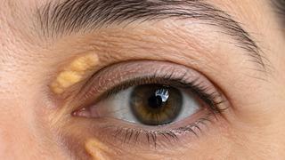 Gözünüzün çevresindeki bu işarete dikkat! Kalp krizinin habercisi olabilir
