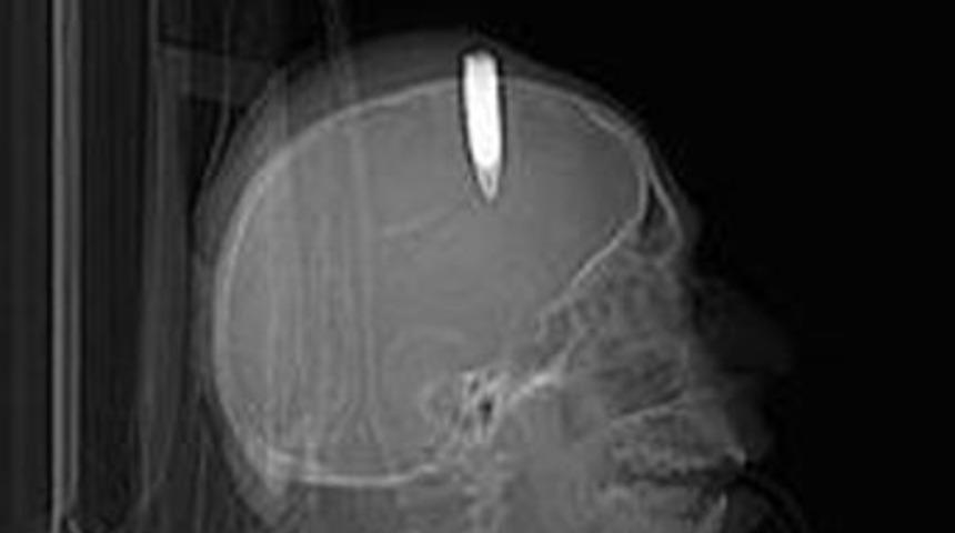 34 yıldır kafasında mermi ile yaşıyor