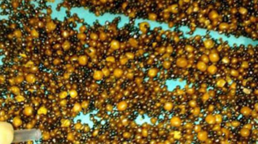 Safra kesesinden 8 bin 422 taş &ccedil;ıktı