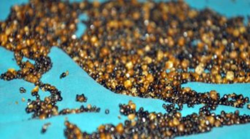 Hastanın safra kesesinden 8 bin 422 taş &ccedil;ıktı