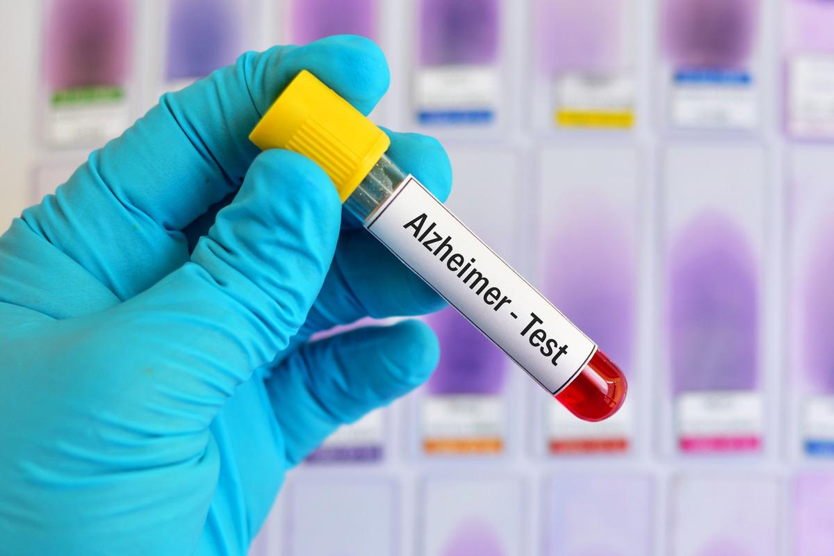 Dişlerdeki bu belirtiyi hafife almayın! Alzheimer riski yüzde 61 daha yüksek 3